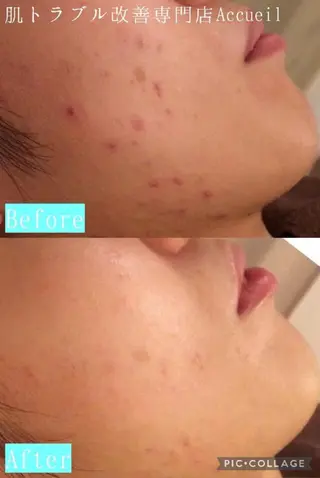 夏までに肌荒れ卒業 するサロン🌻のエステ・リラクイメージ