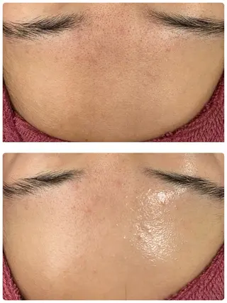 Chalon所属・REVI取扱・肌悩み 毛穴Chalonのエステ・リラクイメージ