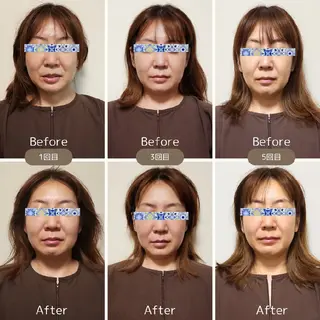 即効⚡小顔美容鍼🪡 むくみたるみ脂肪解消のエステ・リラクイメージ