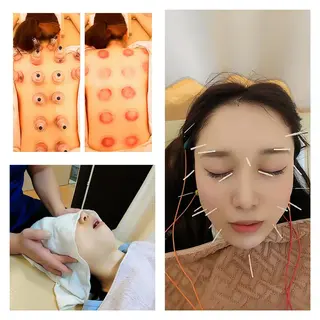 リフトアップ・たるみ ☆美容鍼小顔矯正のその他イメージ