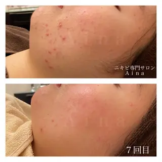 ミディアム カラー パーマ ヘアアレンジ メンズ キッズ ネイル マツエク・マツパ ニキビ跡専門サロン Ａｉｎａのエステ・リラクイメージ