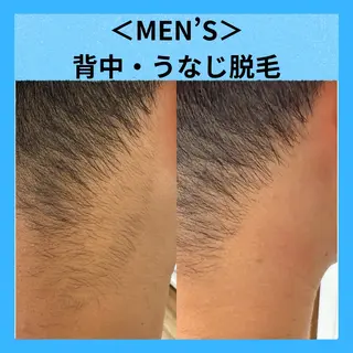 【地域最安値】脱毛/ フェイシャル　山下のエステ・リラクイメージ