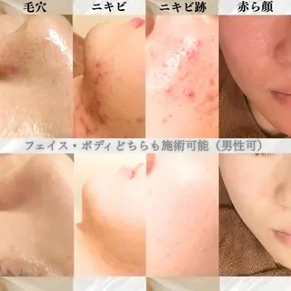 6万人の美肌実績🔥 最短ニキビ改善のエステ・リラクイメージ