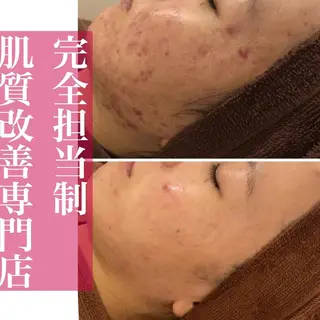 夏までに肌荒れ卒業 するサロン🌻のエステ・リラクイメージ