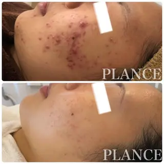 フェイシャル専門 肌質改善/プランスのエステ・リラクイメージ