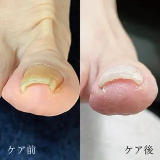 ネイル 深爪・巻き爪 専門サンセリテのネイルデザイン