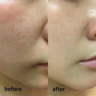 ハーブピーリング/韓国肌管理/フェイシャル/毛穴洗浄/眉毛/顔脱毛【糸脱毛専門】rev所属・ハーブピーリング🌹 毛穴洗浄❤️眉waxのエステ・リラクイメージ