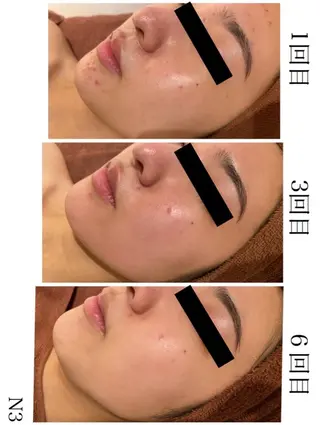 学生ニキビ改善🍀 優しい肌質改善のエステ・リラクイメージ