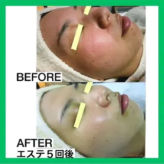 ニキビケア◇ニキビ跡 レゾン京橋店　峠山のエステ・リラクイメージ