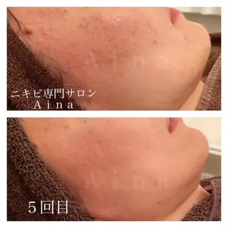 ロング カラー パーマ ヘアアレンジ メンズ キッズ マツエク・マツパ ニキビ跡専門サロン Ainaのエステ・リラクイメージ