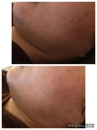 ニキビ/肌質改善専門 Snow skinのエステ・リラクイメージ