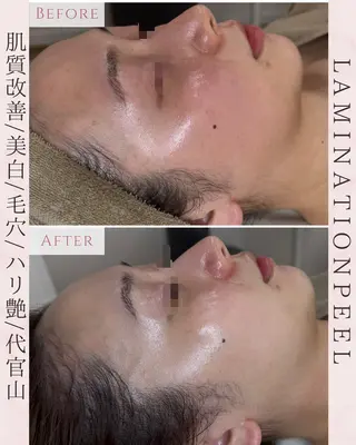 【ハーブピーリング/韓国ツヤ肌ピーリング】RelierBelle-ルリエベル-所属・肌質改善/肌育特化 プライベートサロンのエステ・リラクイメージ