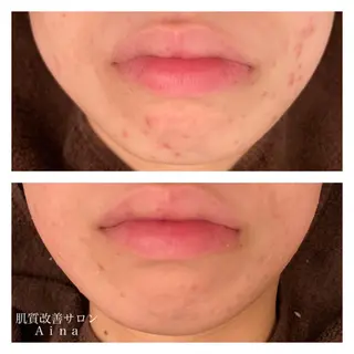 ショート カラー パーマ ヘアアレンジ メンズ キッズ ネイル マツエク・マツパ ニキビ跡専門サロン Ａｉｎａのエステ・リラクイメージ