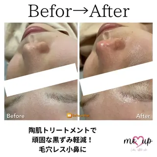 Meupニキビ専門店 背中/ハーブ/肌管理のその他イメージ