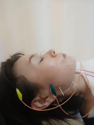 リフトアップ・たるみ ☆美容鍼小顔矯正のその他イメージ