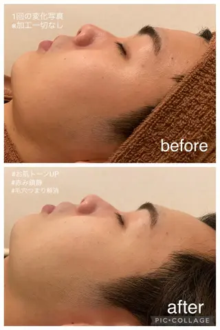 夏までに肌荒れ卒業 するサロン🌻のエステ・リラクイメージ