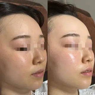 mieux所属・ハーブピーリング ¥6600のエステ・リラクイメージ