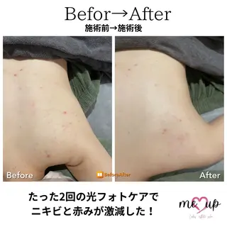 Meupニキビ専門店 背中/ハーブ/肌管理のその他イメージ