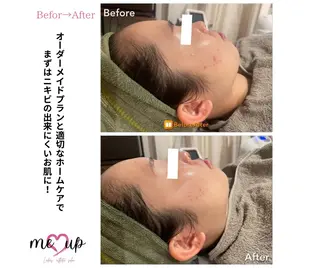 Meupニキビ専門店 背中/ハーブ/肌管理のその他イメージ