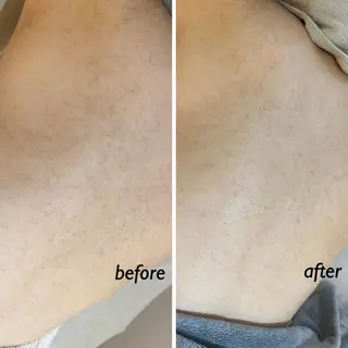 うなじ脱毛/美肌脱毛 LABELのエステ・リラクイメージ