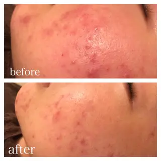 セミロング マツエク・マツパ ニキビ跡専門サロン Ａｉｎａのエステ・リラクイメージ