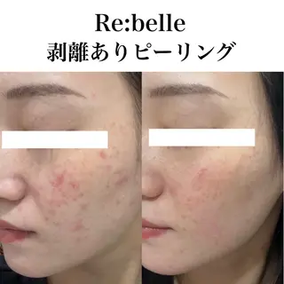 ハーブピーリング/ 艶肌wax/リララのエステ・リラクイメージ