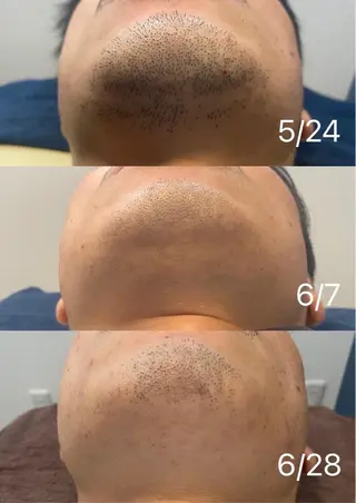 脱毛 シエスタ 山下 上級脱毛士のエステ・リラクイメージ