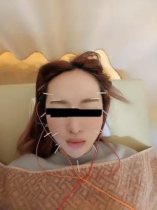 リフトアップ・たるみ ☆美容鍼小顔矯正のその他イメージ