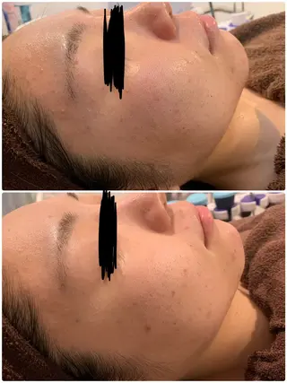 肌質改善ハーブピー リング🌿RINAのエステ・リラクイメージ