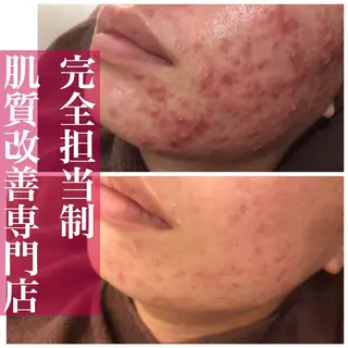 ミディアム パーマ ネイル マツエク・マツパ アイブロウ ニキビ・肌質改善専門 ♡人生が変わるサロンのエステ・リラクイメージ