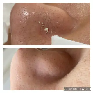 毛穴ケア・肌質改善 徳川のエステ・リラクイメージ