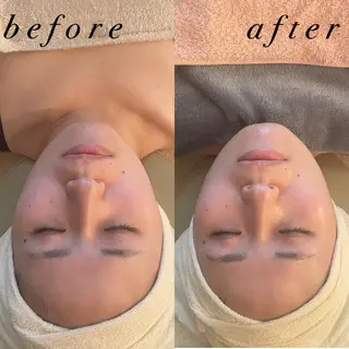 うなじ脱毛/美肌脱毛 LABELのエステ・リラクイメージ