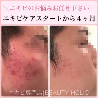 ニキビ・ 肌荒れ専門店のエステ・リラクイメージ