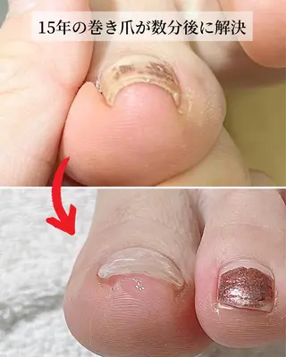 ネイル 深爪・巻き爪 専門サンセリテのネイルデザイン