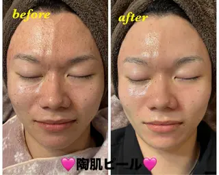 ハーブピーリング/韓国肌管理/フェイシャル/毛穴洗浄/眉毛/顔脱毛【糸脱毛専門】rev所属・ハーブピーリング🌹 毛穴洗浄❤️眉waxのエステ・リラクイメージ