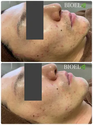 BeSkin藤沢店所属・ニキビ/肌質改善 BeSkin 藤沢店のエステ・リラクイメージ