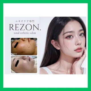 ニキビケア◇ニキビ跡 レゾン京橋店　峠山のエステ・リラクイメージ
