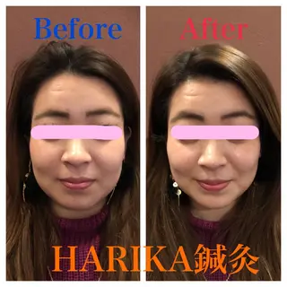 HARIKA鍼灸所属・HARIKA 鍼灸のその他イメージ
