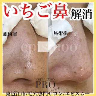 epismoo 脱毛/HBL/毛穴の眉毛・アイブロウイメージ