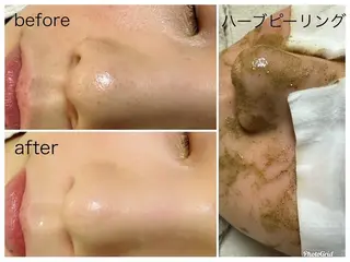 ハーブピーリング/韓国肌管理/フェイシャル/毛穴洗浄/眉毛/顔脱毛【糸脱毛専門】rev所属・ハーブピーリング🌹 毛穴洗浄❤️眉waxのエステ・リラクイメージ