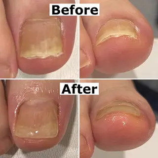 ネイル Mellow nail所属・巻爪無料モデル募集 ✨🦶MEGUMIのネイルデザイン