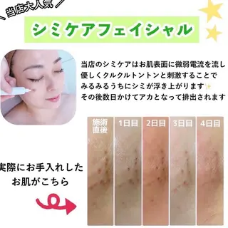 【ニキビ/肌管理】 salon varyのエステ・リラクイメージ