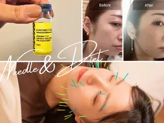 即効⚡小顔美容鍼🪡 むくみたるみ脂肪解消のエステ・リラクイメージ