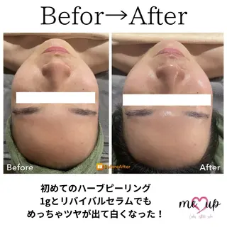 Meupニキビ専門店 背中/ハーブ/肌管理のその他イメージ