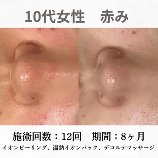 重度ニキビ専門🌷 ダウンタイムなしのエステ・リラクイメージ