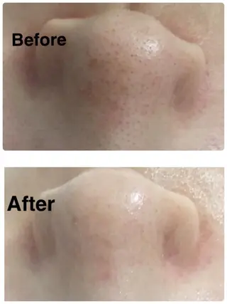 Meupニキビ専門店 背中/ハーブ/肌管理のその他イメージ