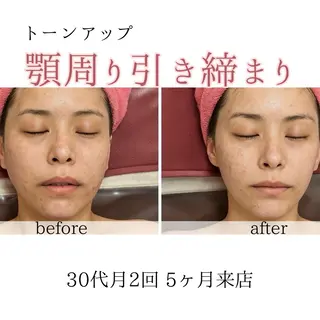 オアシス・さくら所属・小顔（シミ ニキビ）脱毛サロンのエステ・リラクイメージ