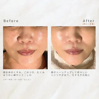 繰り返すニキビを改善 ✨つくば肌質改善専門のエステ・リラクイメージ