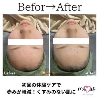 Meupニキビ専門店 背中/ハーブ/肌管理のその他イメージ