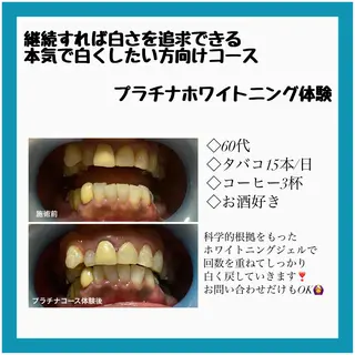 ネイル/耳つぼ /新ホワイトニングのネイルデザイン